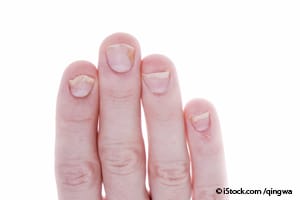 손톱을 통해 알 수 있는 건강 상태 10가지