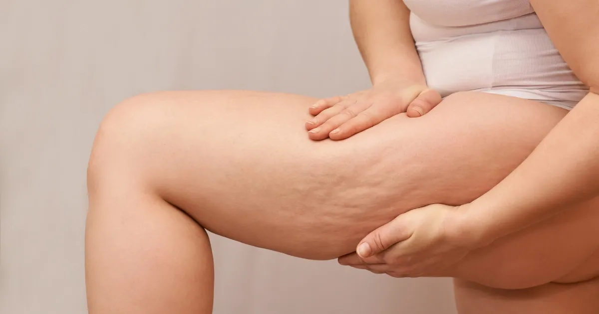 셀룰라이트를 자연스럽게 관리하려면 어떻게 해야 하나요?
