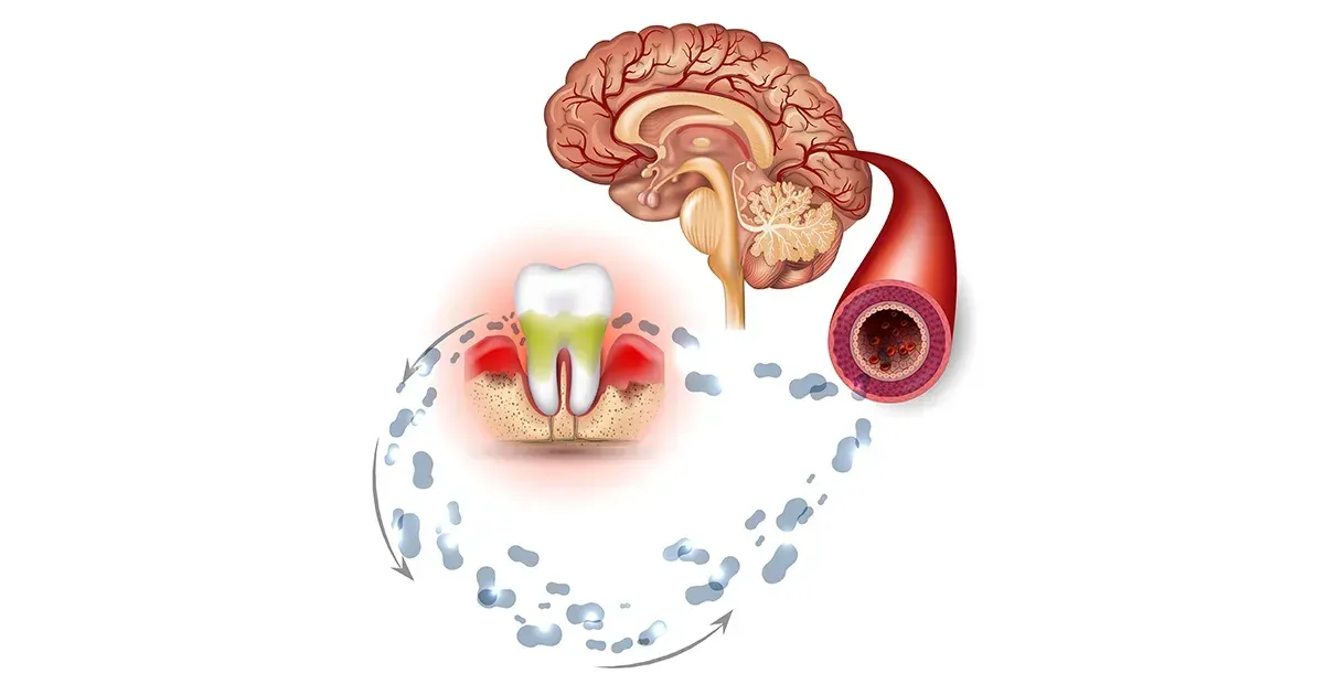 구강 미생물군이 치매 위험에 미치는 영향